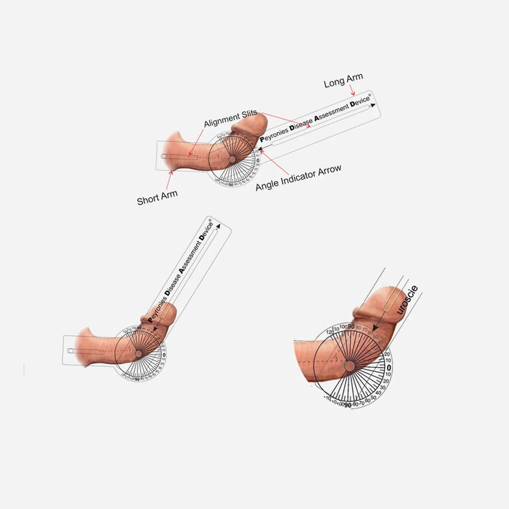 P.D.A.D. – Peyronie Hastalığı Eğrilik Ölçüm Cihazı - | Üroloji Market